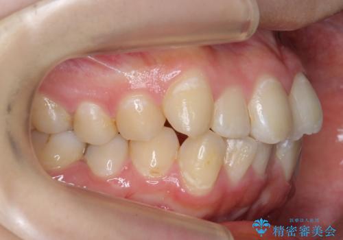 20代女性　前歯のねじれ・出っ歯　インビザラインで奥歯を下げて抜かずに治療の治療前