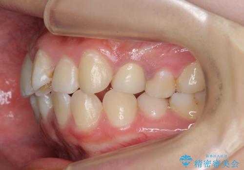 20代女性　前歯のねじれ・出っ歯　インビザラインで奥歯を下げて抜かずに治療の治療前