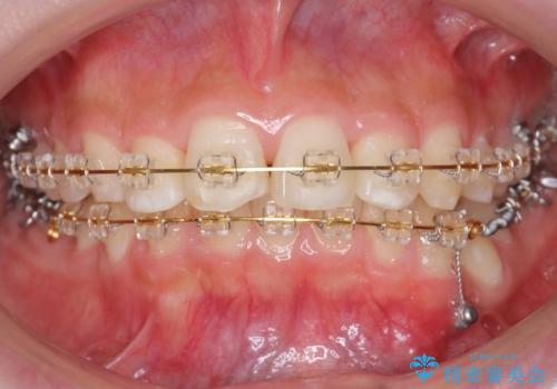 30代女性　抜かない矯正　出っ歯　低位歯を並べましたの治療中