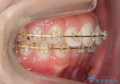 30代女性　抜かない矯正　出っ歯　低位歯を並べましたの治療中