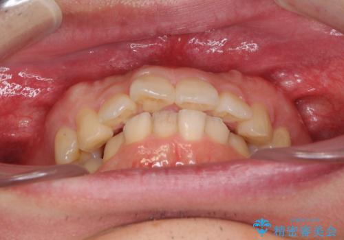 気になる出っ歯をインビザラインで改善の治療前