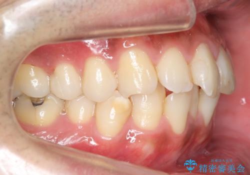30代男性　歯を抜かないインビザライン　前歯のがたつきの治療の治療前