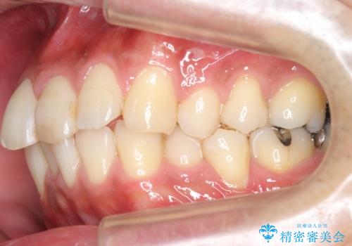 30代男性　歯を抜かないインビザライン　前歯のがたつきの治療の治療前