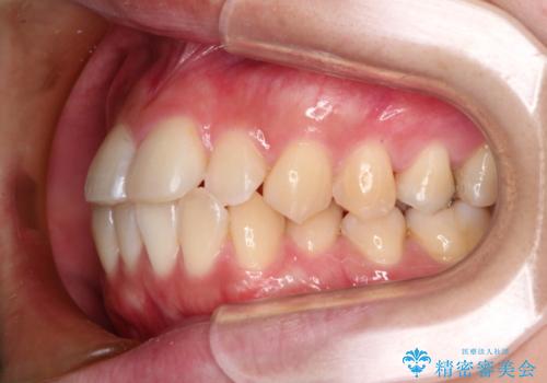インビザラインでガタガタの治療　かんでいない奥歯を正しい位置への治療前