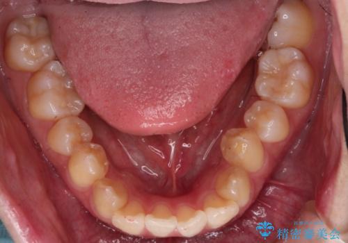 インビザラインでガタガタの治療　かんでいない奥歯を正しい位置への治療前