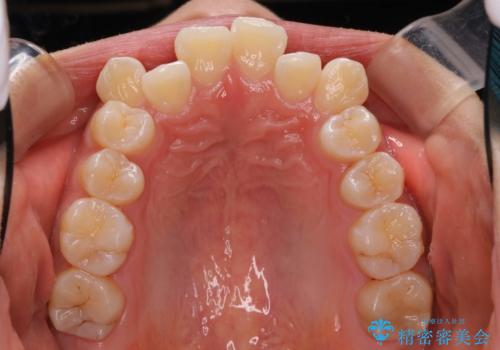 王道・従来のワイヤー矯正　表の装置で手早くきれいな歯並びをの治療前