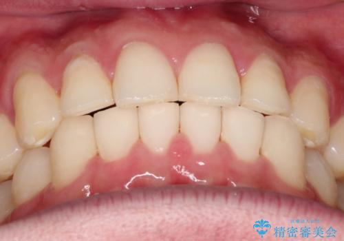 上の前歯に隙間ある　インビザラインによる目立たない矯正の治療後