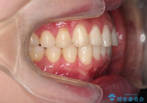 上の前歯に隙間ある　インビザラインによる目立たない矯正の治療後