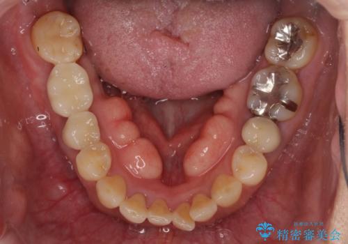 抜けたまま放置した奥歯　部分矯正やインプラントを用いた咬合回復の治療後