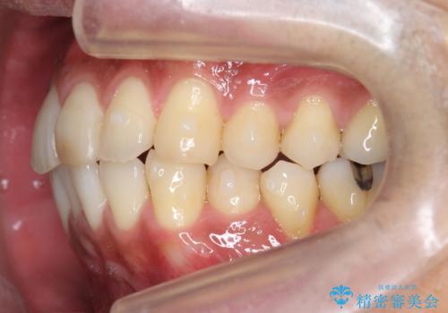 30代男性　歯を抜かないインビザライン　前歯のがたつきの治療の治療中