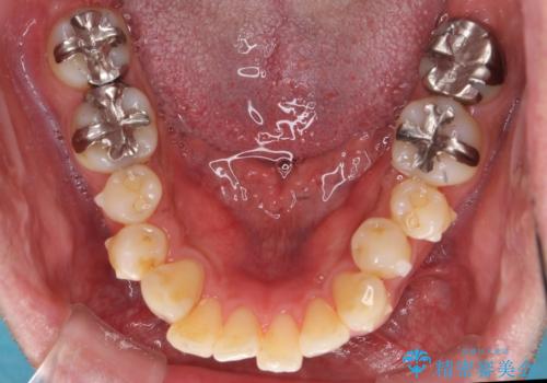30代男性　歯を抜かないインビザライン　前歯のがたつきの治療の治療中