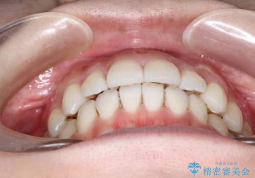 インビザラインでガタガタの治療　かんでいない奥歯を正しい位置への治療後