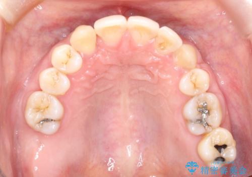 重度歯周炎の歯を抜歯してワイヤー矯正を　変則的なかみ合わせで仕上げるの治療後