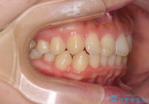 前歯のすきっぱ　マウスピース矯正～ASOアライナー～の治療後