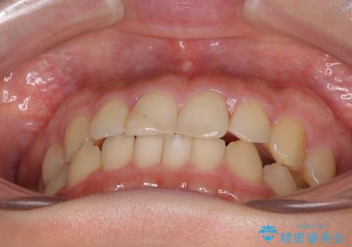 前歯のすきっぱ　マウスピース矯正～ASOアライナー～の治療後