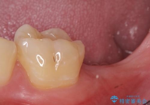 インプラント治療　虫歯で失った歯の補綴の治療前