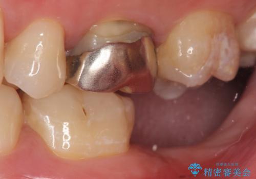 インプラント治療　虫歯で失った歯の補綴の治療前