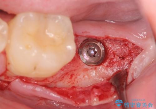 インプラント治療　虫歯で失った歯の補綴の治療中