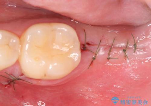 インプラント治療　虫歯で失った歯の補綴の治療中
