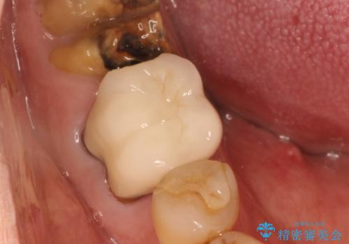 下の奥歯のインプラントと根管治療での咬合回復の治療前