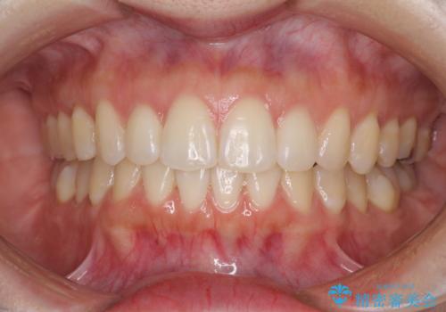 前歯のデコボコと出っ歯を治したい　インビザラインによる非抜歯矯正治療