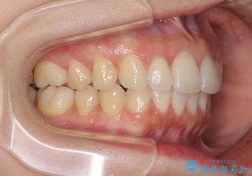 前歯のデコボコと出っ歯を治したい　インビザラインによる非抜歯矯正治療の治療後