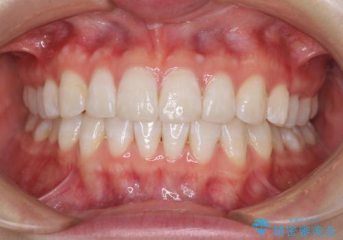 インビザライン・ライトによる前歯部叢生の改善の治療後