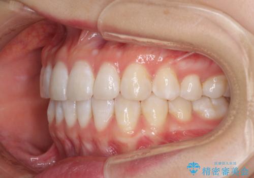 インビザライン・ライトによる前歯部叢生の改善の治療後