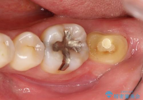 他院で仮歯が壊れまくる　高さの無い歯のゴールドクラウンの治療前