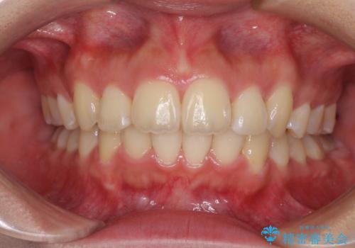 前歯の出っ歯とでこぼこ　目立たないワイヤーで抜歯矯正