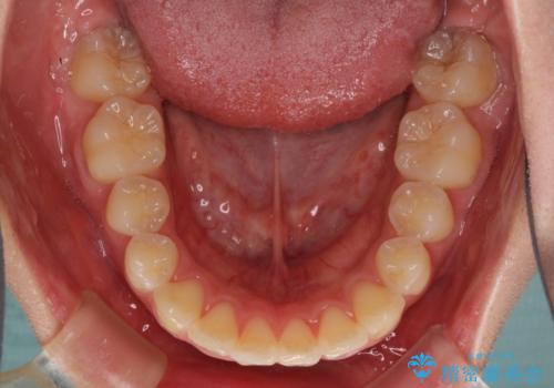 前歯の出っ歯とでこぼこ　目立たないワイヤーで抜歯矯正の治療後