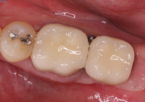 インプラント周囲の歯肉移植～最終的なセラミックを入れるまでの治療後