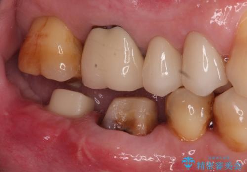 下の奥歯のインプラントと根管治療での咬合回復の治療中
