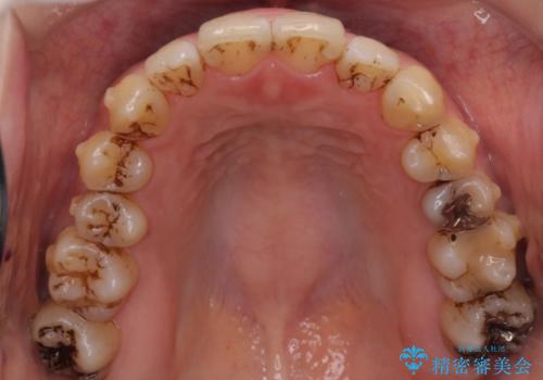 インビザラインでガタガタの治療　かんでいない奥歯を正しい位置への治療中