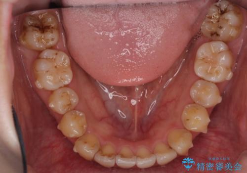 インビザラインでガタガタの治療　かんでいない奥歯を正しい位置への治療中