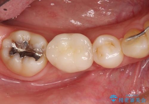 しっかり噛める奥歯。インプラント治療の治療後