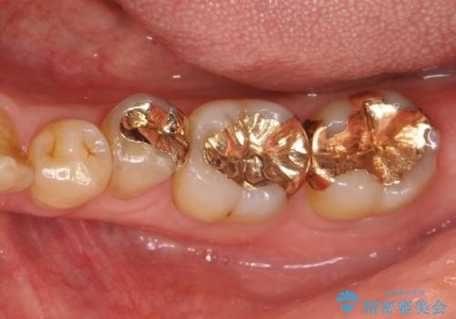 ゴールドインレーにも2次虫歯　再びゴールドインレーにてやり直しの治療後