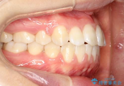 王道・従来のワイヤー矯正　表の装置で手早くきれいな歯並びをの治療後