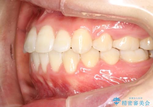 王道・従来のワイヤー矯正　表の装置で手早くきれいな歯並びをの治療後