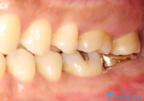 他院で仮歯が壊れまくる　高さの無い歯のゴールドクラウンの治療後