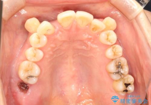 重度歯周炎の歯を抜歯してワイヤー矯正を　変則的なかみ合わせで仕上げるの治療前