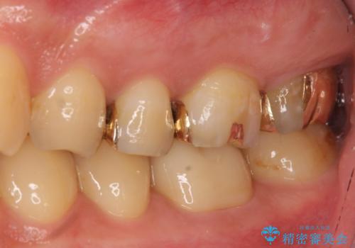 奥歯の精密虫歯治療の治療後