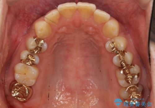 奥歯の精密虫歯治療の治療後