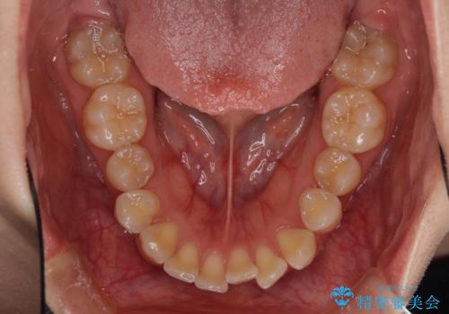 前歯のデコボコと出っ歯を治したい　インビザラインによる非抜歯矯正治療の治療前