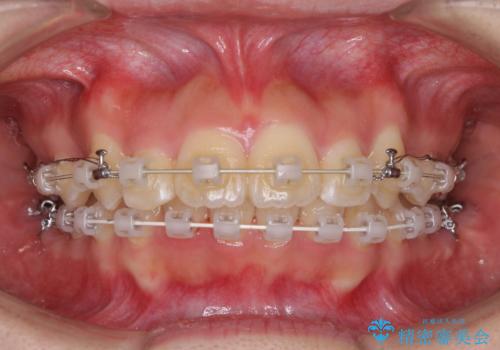 前歯の出っ歯とでこぼこ　目立たないワイヤーで抜歯矯正の治療中