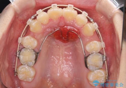 前歯の出っ歯とでこぼこ　目立たないワイヤーで抜歯矯正の治療中