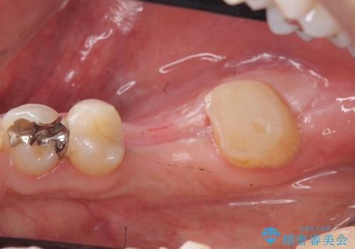 オールセラミッククラウン・歯冠長延長術　抜歯後の補綴の治療前