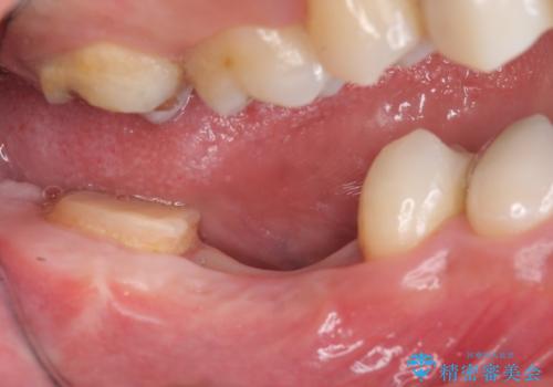 オールセラミッククラウン・歯冠長延長術　抜歯後の補綴の治療前
