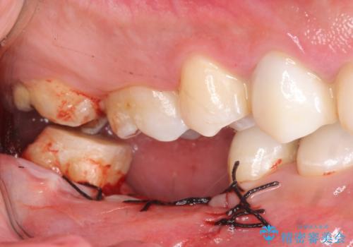 オールセラミッククラウン・歯冠長延長術　抜歯後の補綴の治療後