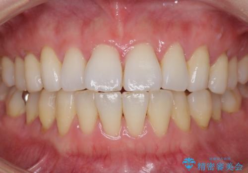 PMTC+ホワイトニングエクセレントコースで白く輝く歯に。の治療前